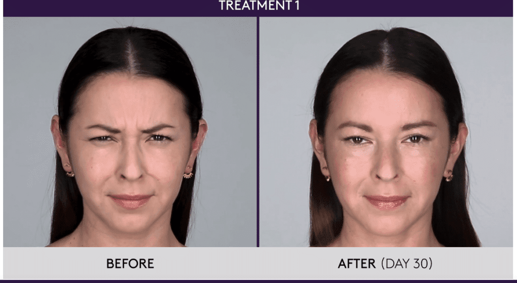 Botox Treatment Near Me | Pricing Boston